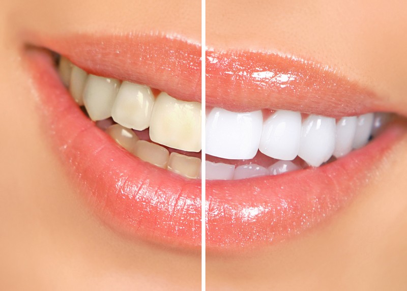 Teeth Whitening  Phoenix, AZ 